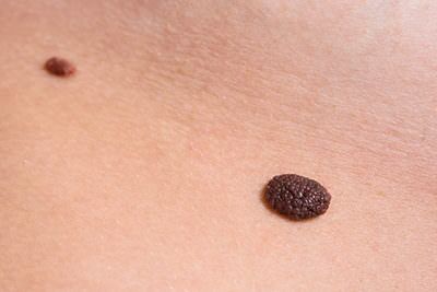 Pigmented Nevus Removal Surgery, Melanocytic Medical Procedure - Tahiri  Plastic Surgery
